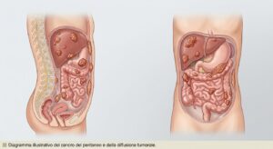 mesotelioma peritoneale o cancro al peritoneo